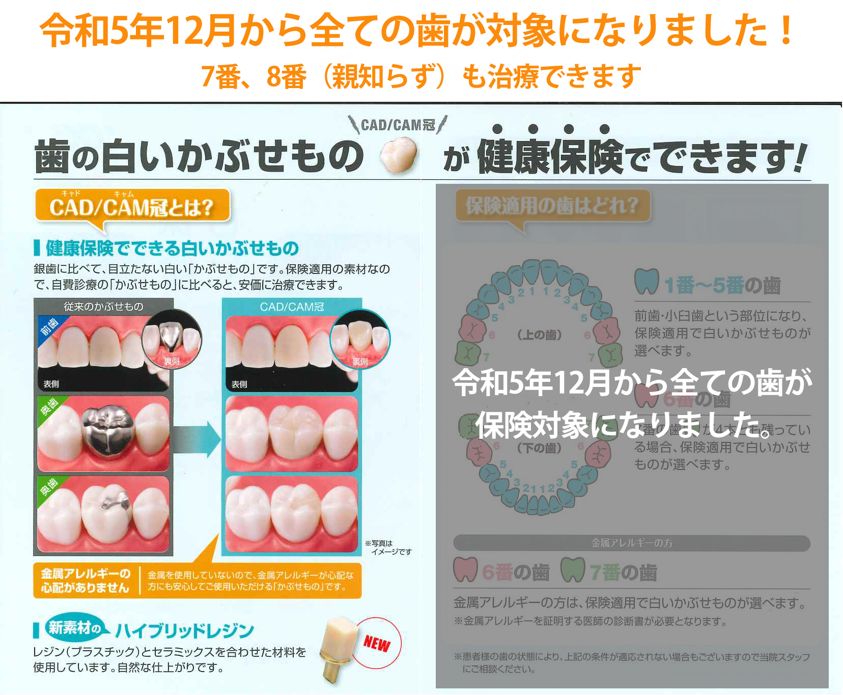 CADCAM（白い歯・保険診療）